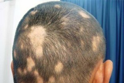 Очаговая алопеция