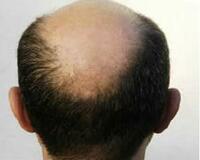 Облысение - от 250 000 сум