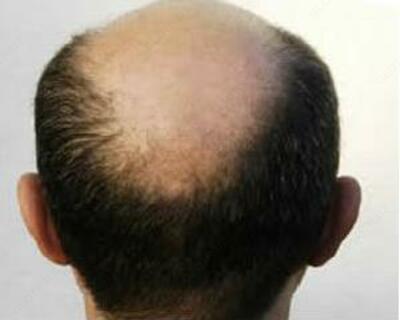 Облысение - от 250 000 сум