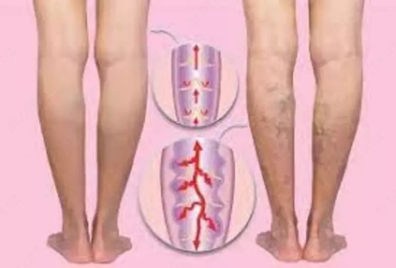  Max Effect (Макс Эффект) - крем от варикоза купить в Ташкенте Только в розницу