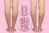  Max Effect (Макс Эффект) - крем от варикоза купить в Ташкенте Только в розницу