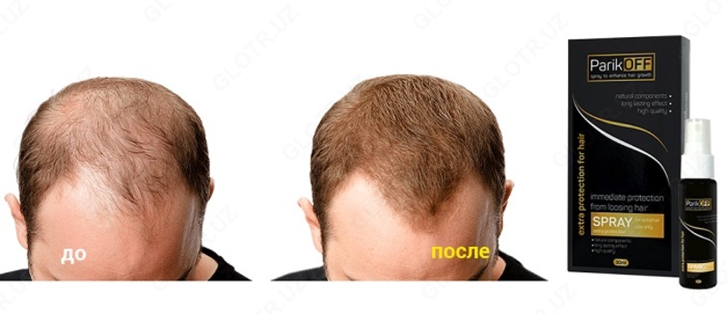 Спрей для волос ParikOff от облысения: редкие  ломкие  тусклые волосы — теперь в прошлом!
