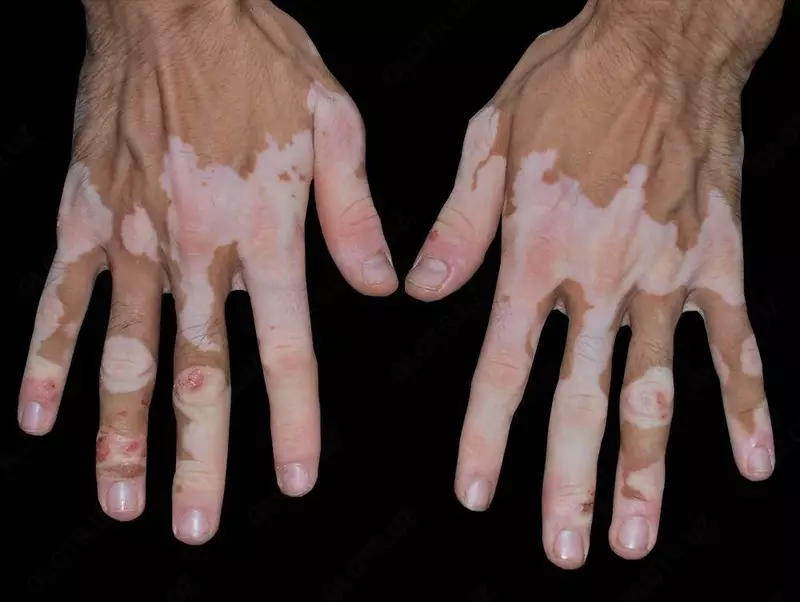 Натуральное тибетское лекарство от витилиго