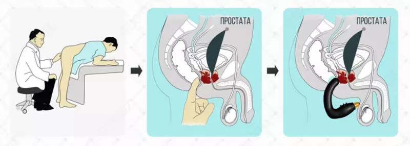  Урологический массажёр для простаты PROSTATA HELP MP-1 купить в Ташкенте - 