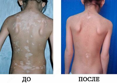 Средство от Витилиго - 159 000 сум / шт.