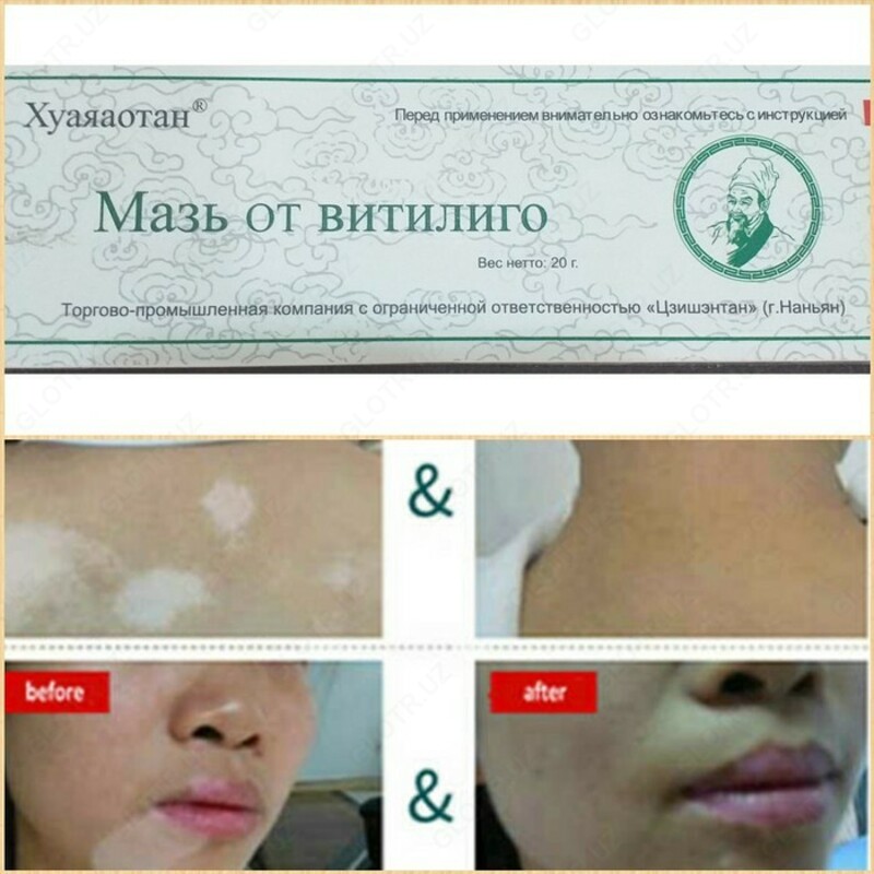 Vitiligo Huayaaotan uchun malham