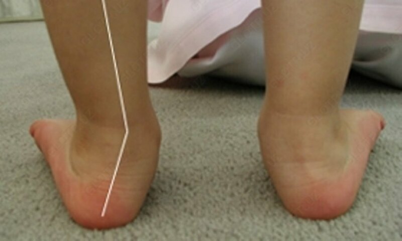Исправление вальгусной деформации стопы с помощью ЛФК