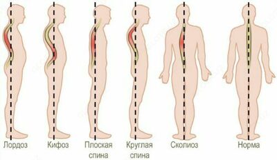 Профилактика искривления осанки с помощью ЛФК