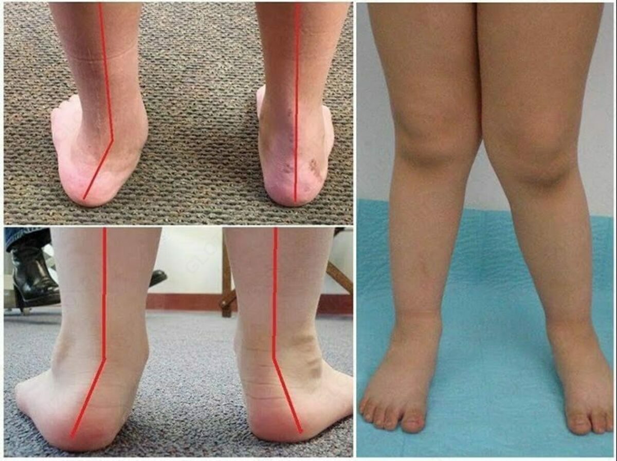 Плоскостопие у детей врач. Плоскостно вальгусные стопы. Плоско-вальгусная деформация стоп. Эквино вальгусная деформация стопы. Вальгусная и варусная деформация стопы.