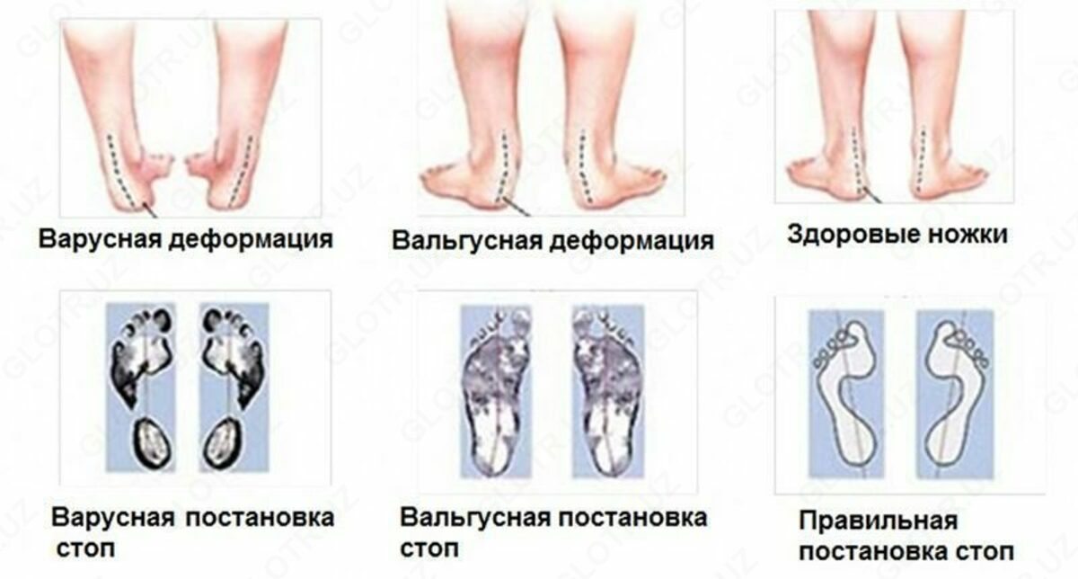 Correction of complex foot deformities using the V-osteotomy and the Ilizarov te