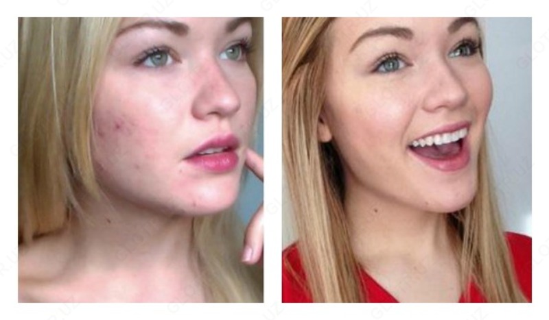 Shi Fe Shi препарат от прыщей