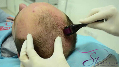 Дермароллер,мезороллер soch soqol o'stradi