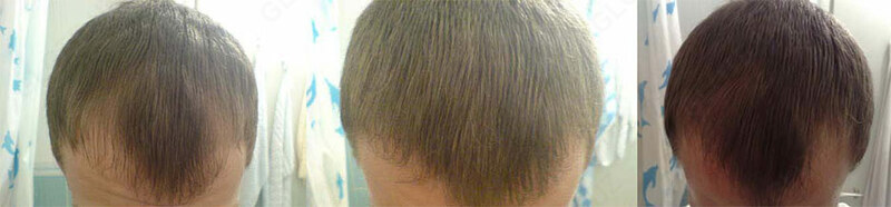 Hair4u 10% для роста волос и бороды