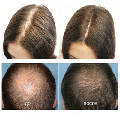 Мinogain 10% (minoxidil) для стимуляция роста волос