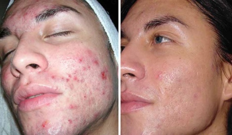 Крем Xi fei shi против прыщей