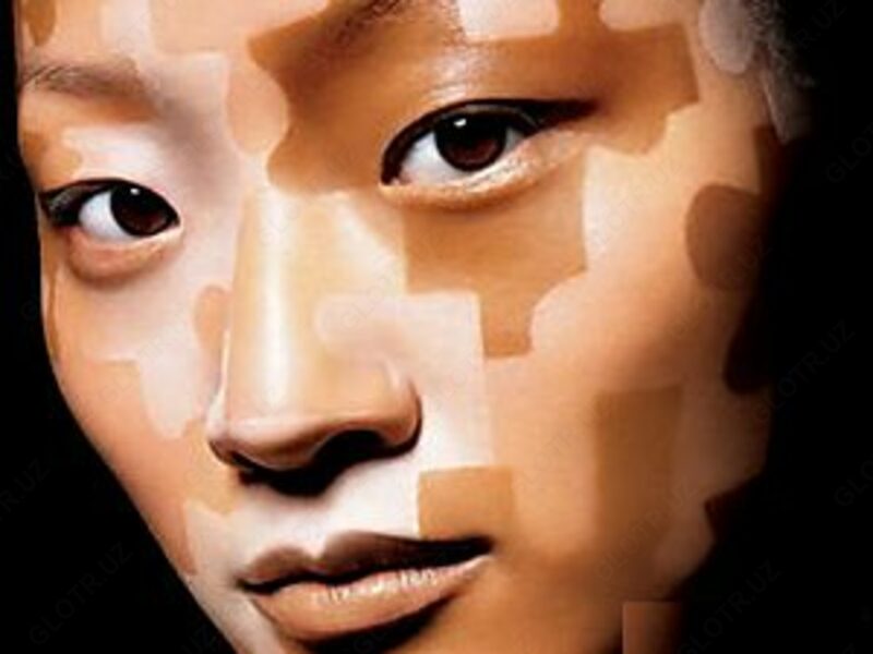 Лосьон для лечения витилиго