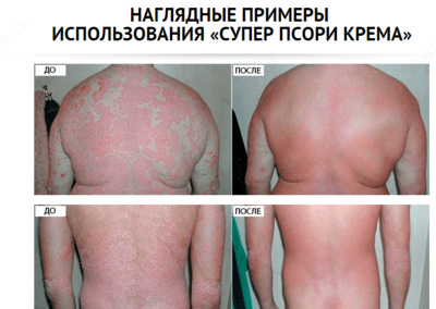 Крем от псориаза Супер Псори (100 мл.)