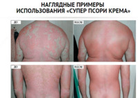 150 000 сум Крем от псориаза Супер Псори (100 мл.)