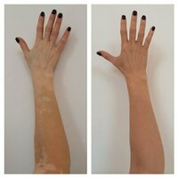 412 000 so'm Viticolor acm (Vitiligo uchun gel)
