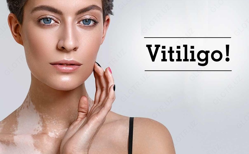 Psoriaz va vitiligodan malham Melanosil (Melanosil)