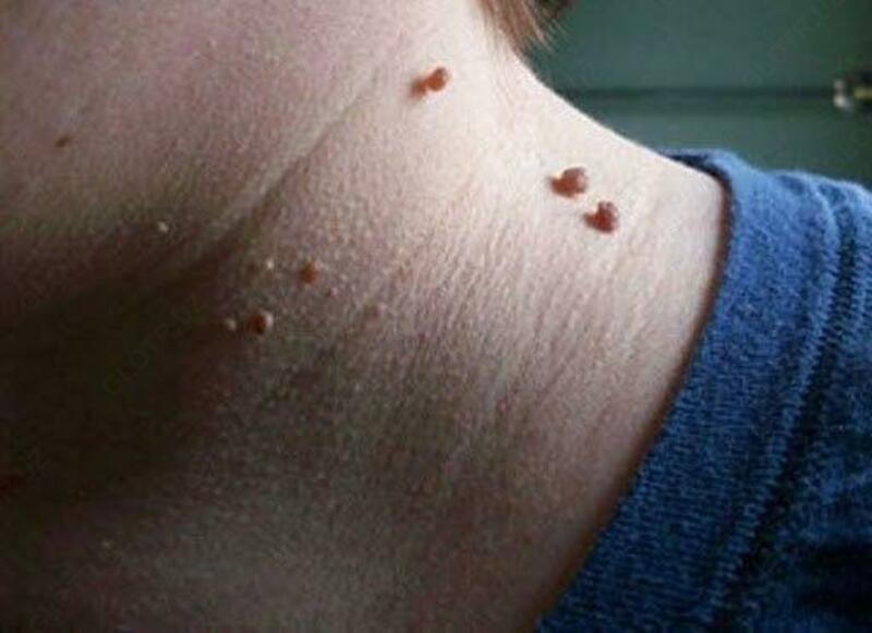 Веррутол (Verrutol) от папилом