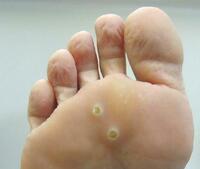 Веррутол (Verrutol) от папилом Только в розницу