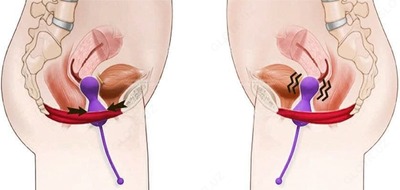 Kegel vaginal to'plar