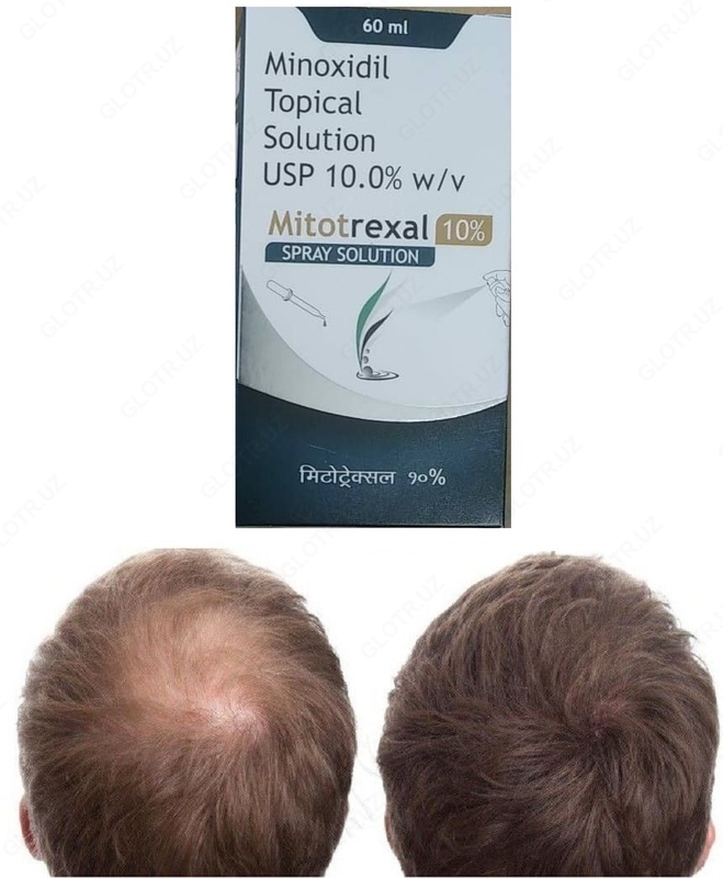 Миноксидил 10% Topical Solution (Mitotrexal 10%)
