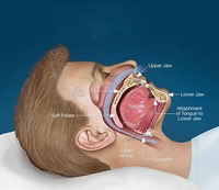 Устройство от храпа Только в розницу