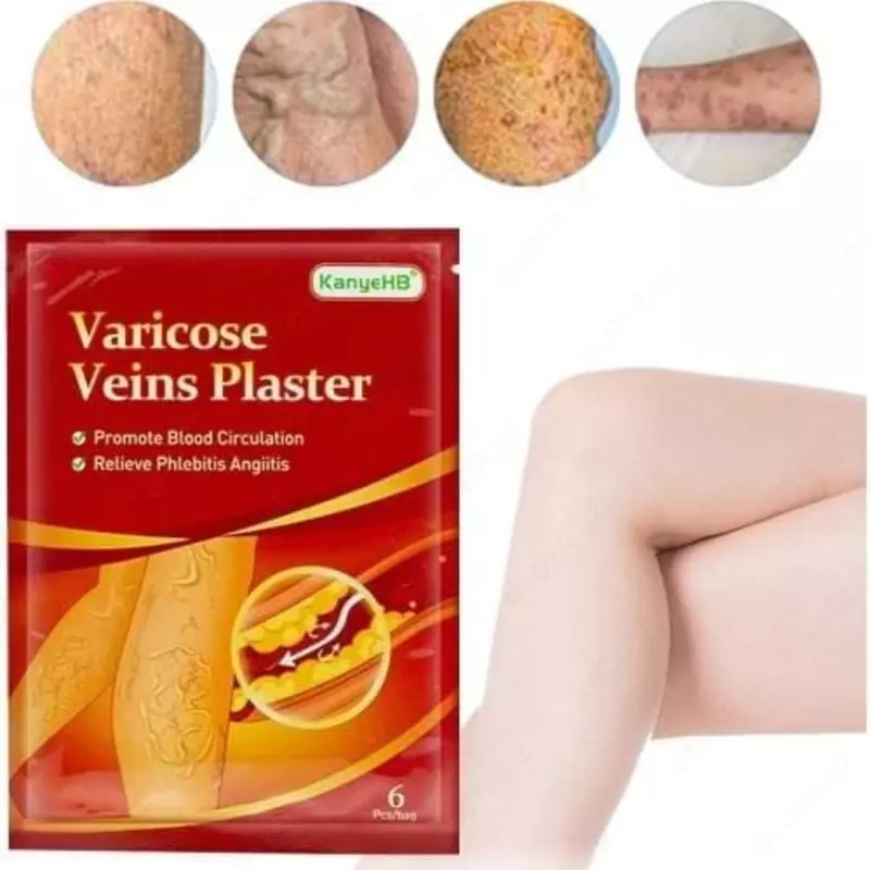 Varikoz tomirlari uchun yamoqlar