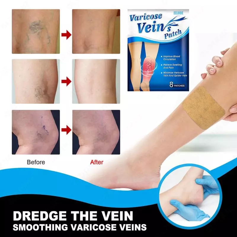 Пластыри от варикозного расширения вен Sumifun