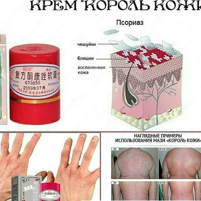 Psoriaz va teri kasalliklari uchun teri malhami shohi