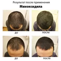 165 000 сум Minoxidil 10% лосьон для роста волос (Таиланд)