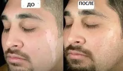 Vitiligoning oq dog'lari uchun damlamasi Vitiligoning oq dog