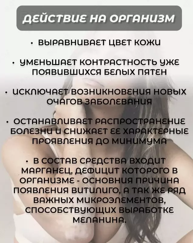 Baydianfen kapsulalari vitiligo bilan kurashish uchun tabiiy vositadir