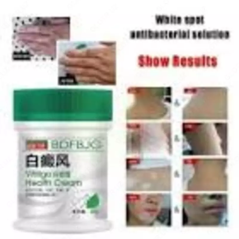 Vitiligo davolash uchun damlamasi 50ml