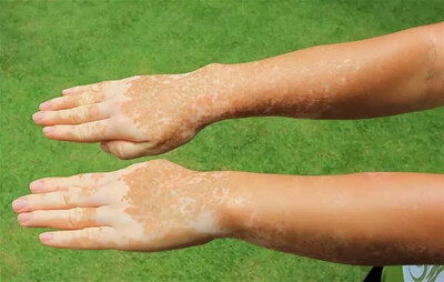 Настойка для лечения ВИТИЛИГО - Yansuan Danjie Ding 30 МЛ концентрированный