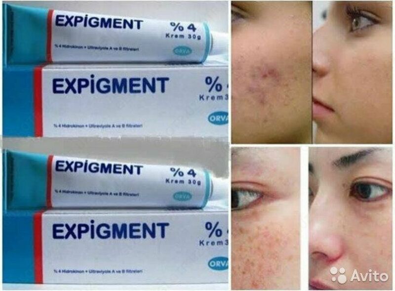 "Expigment" oqartirish kremi