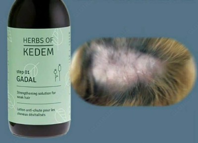 Soch to'kilishiga va sochlarning o'sishiga qarshi tayyorgarlik GADAL