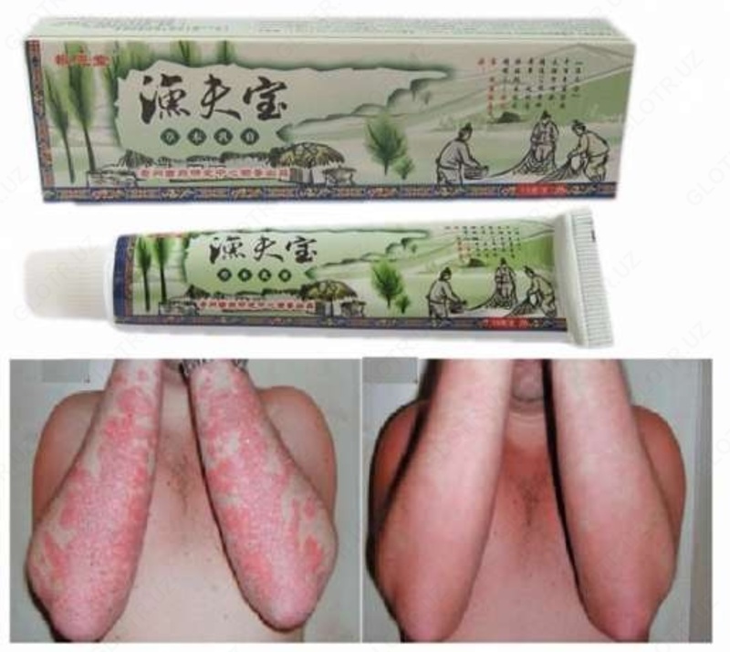 Мазь «Сокровище рыбака» - от псориаза  дерматита  лишая  зуда