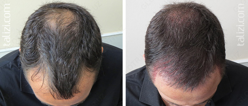 Спрей для волос Tinfal  - 125 000 сум