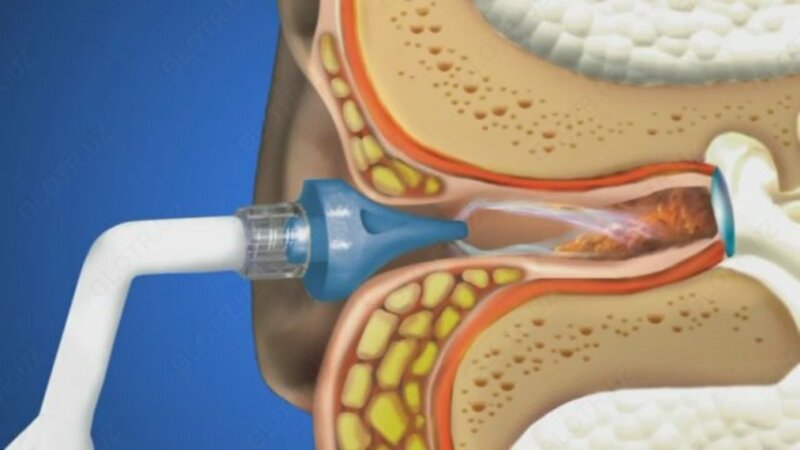 Удаление серной пробки (одно ухо)