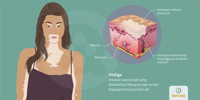 Vitiligo uchun melanotsil tabletkalari - 80 000 so'm / dona