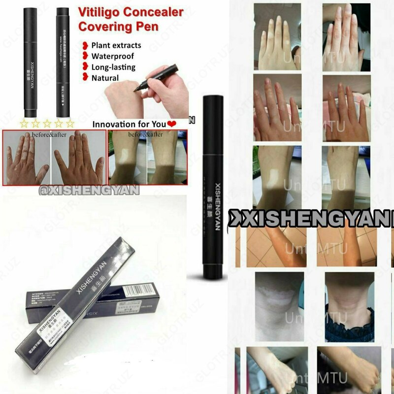 190 000 so'm Vitiligo qoplamali tutqich XISHENGYAN