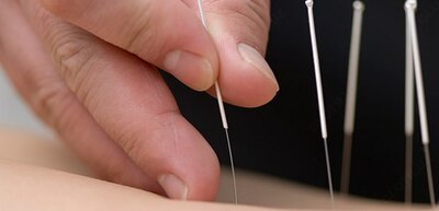 Иглотерапия