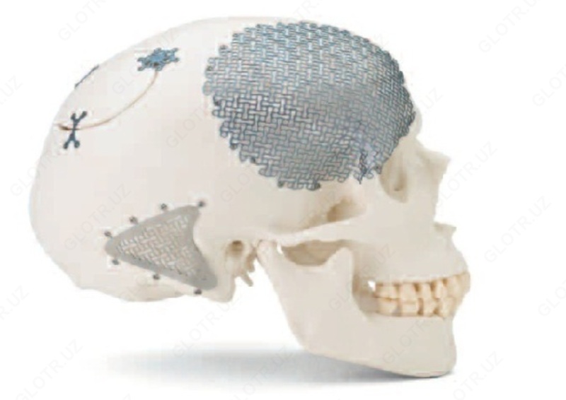  Пластина для краниопластики черепа - 