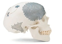  Пластина для краниопластики черепа - 