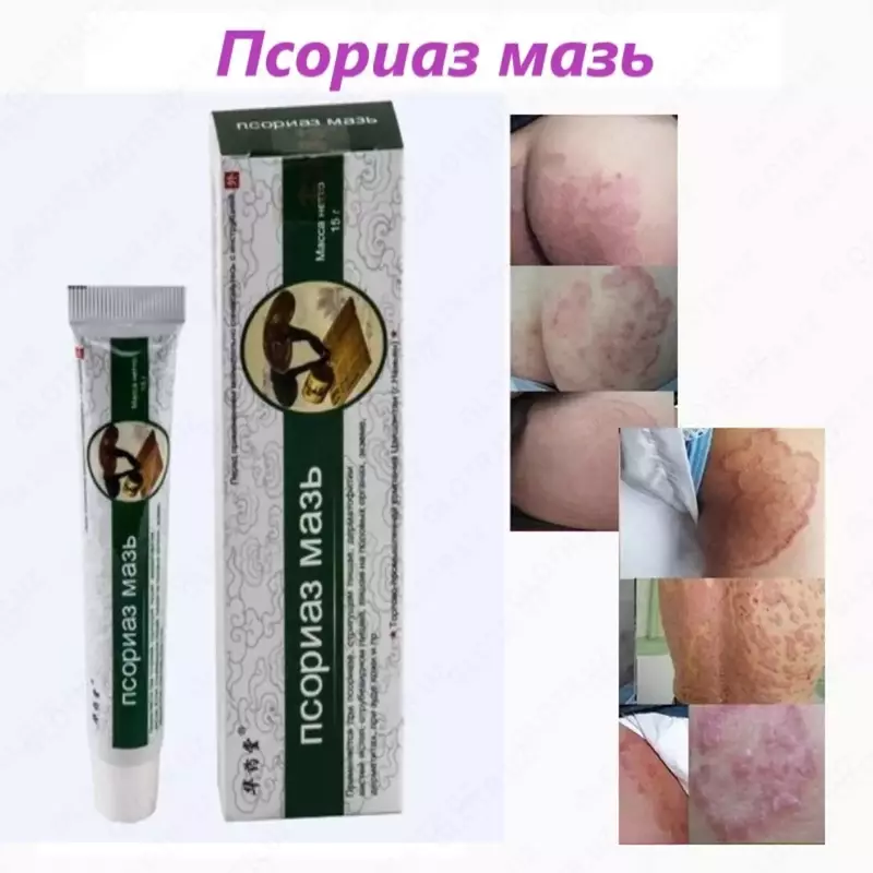 Psoriazga qarshi ajoyib vosita - Original Chakana savdo