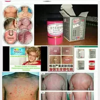 PSORIAZNI DAVOLASH UCHUN TAYSKIY MAZ Chakana savdo