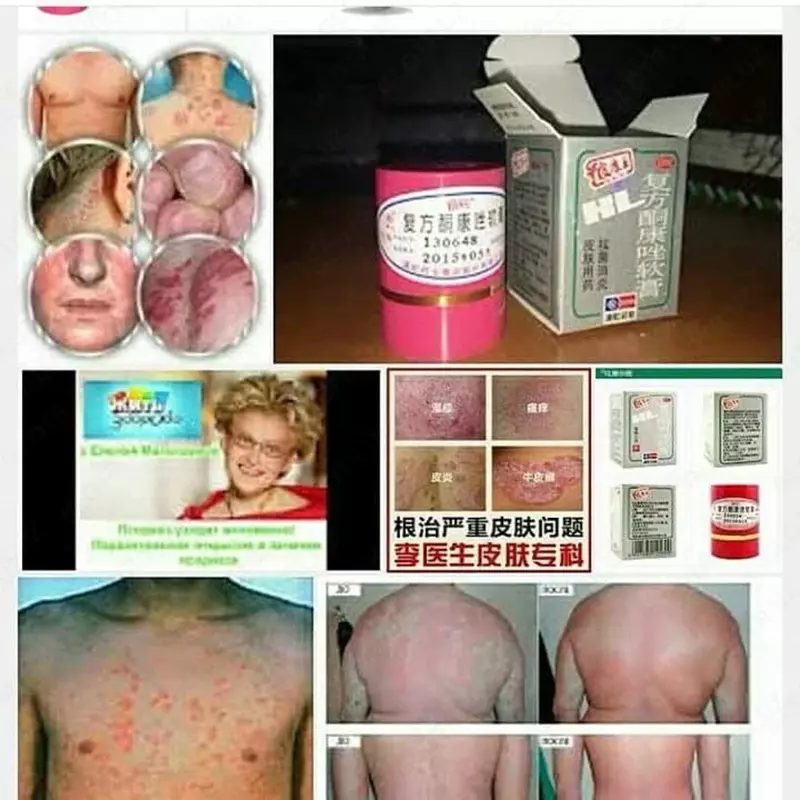 PSORIAZNI DAVOLASH UCHUN TAYSKIY MAZ Chakana savdo